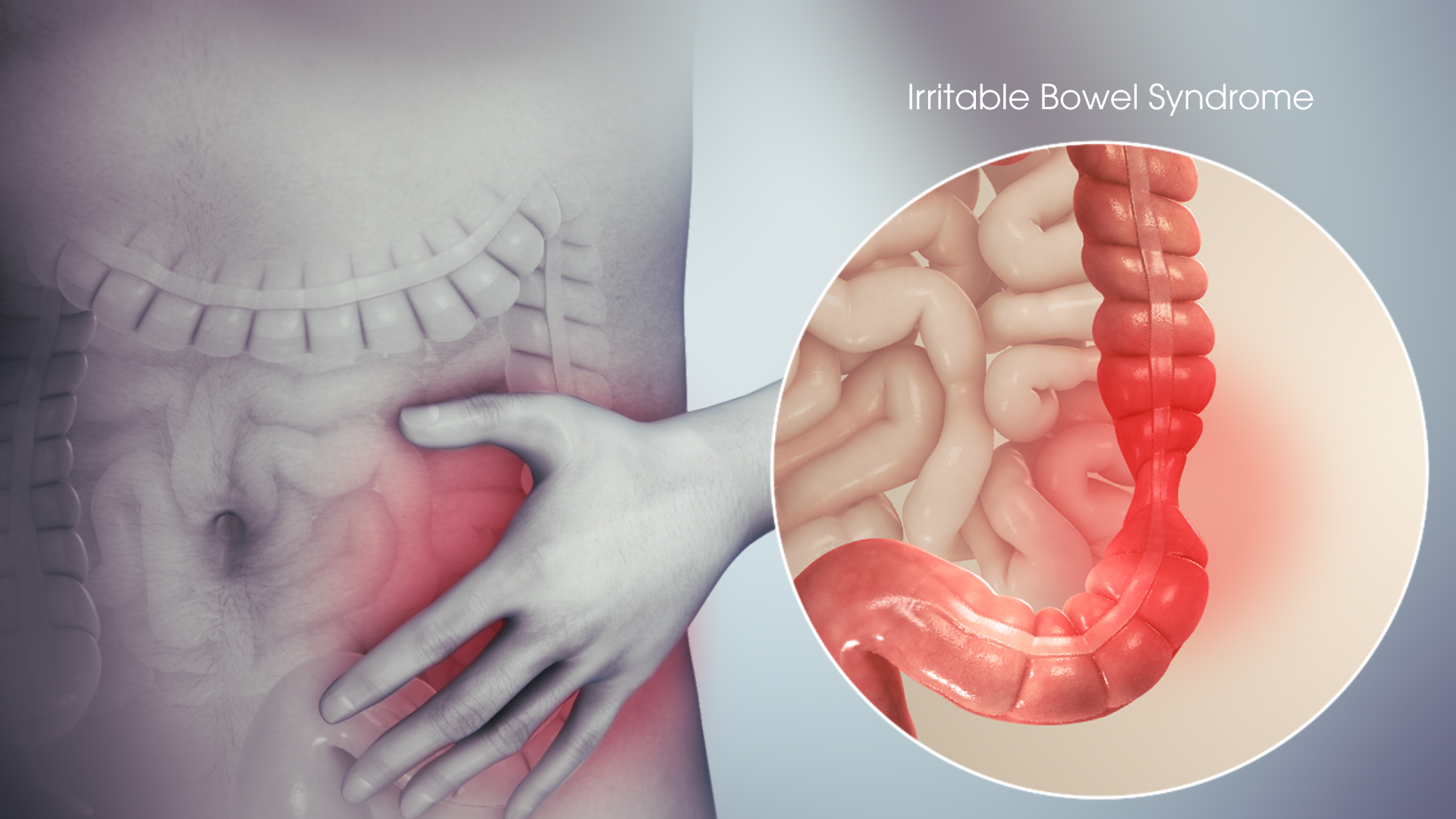 Síndrome do Intestino Irritável - iGastroProcto